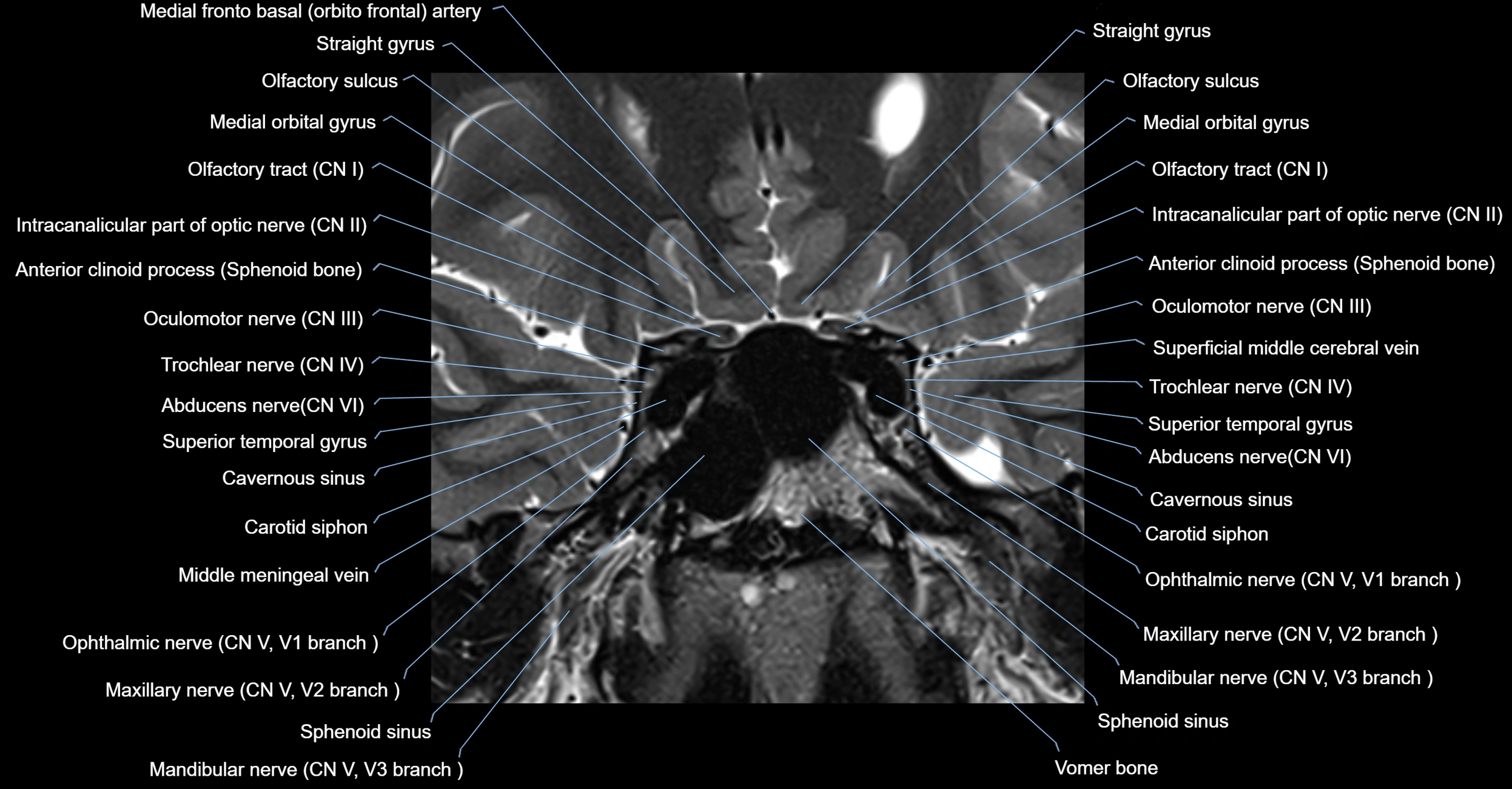 MRI cavernous sinus coronal cross sectional 3T anatomy image-img-00001-00006.webp